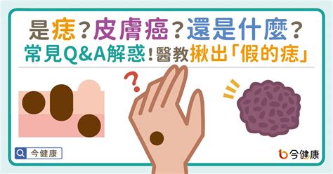 痣 凸起|是痣？皮膚癌？還是什麼？常見Q&A解惑！醫教揪出「。